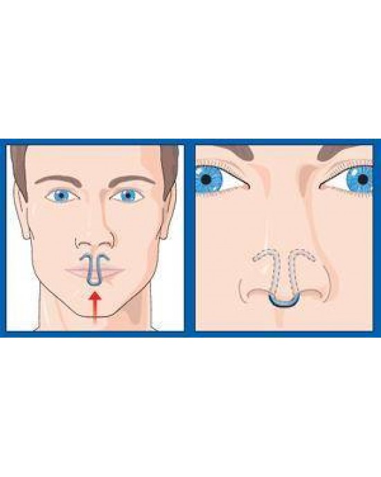 Oscimed ClipAir® Ρινικός Διαστολέας για το Ροχαλητό